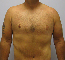 Gynecomastia Before & After Image