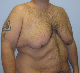 Gynecomastia Before & After Image