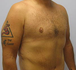 Gynecomastia Before & After Image