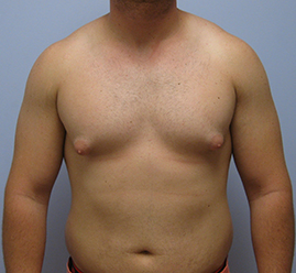 Gynecomastia Before & After Image