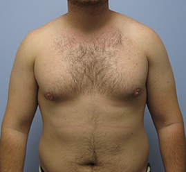 Gynecomastia Before & After Image