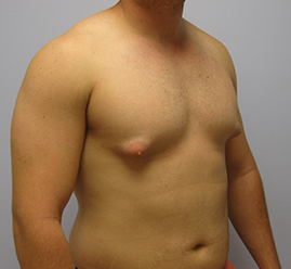 Gynecomastia Before & After Image