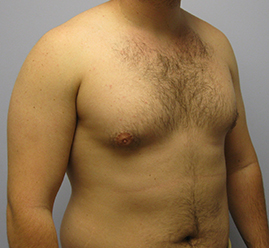 Gynecomastia Before & After Image