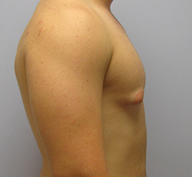 Gynecomastia Before & After Image