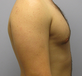 Gynecomastia Before & After Image