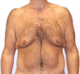 Gynecomastia Before & After Image