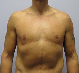 Gynecomastia Before & After Image