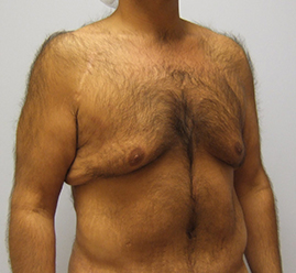 Gynecomastia Before & After Image