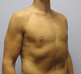 Gynecomastia Before & After Image