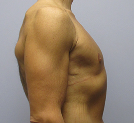 Gynecomastia Before & After Image