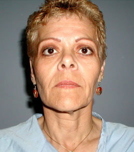 Blepharoplasty Before & After Image