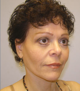 Blepharoplasty Before & After Image