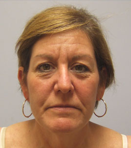 Blepharoplasty Before & After Image