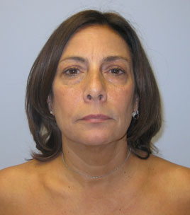 Blepharoplasty Before & After Image