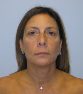 Blepharoplasty Before & After Image