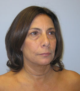 Blepharoplasty Before & After Image