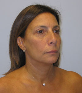 Blepharoplasty Before & After Image