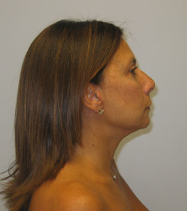 Blepharoplasty Before & After Image