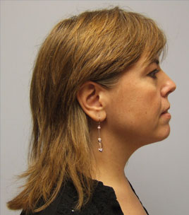 Facelift Before & After Image