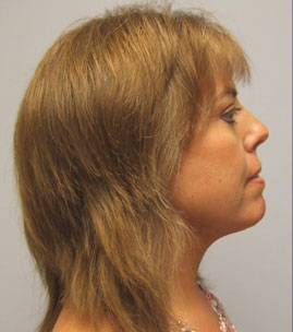 Facelift Before & After Image