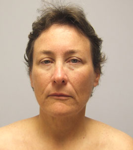 Facelift Before & After Image