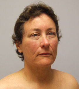 Facelift Before & After Image