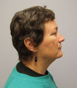 Facelift Before & After Image