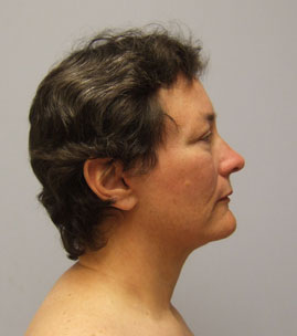 Facelift Before & After Image