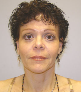 Facelift Before & After Image