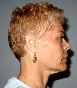 Facelift Before & After Image