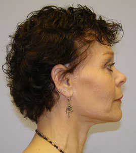 Facelift Before & After Image