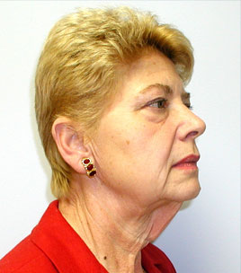 Facelift Before & After Image