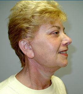 Facelift Before & After Image