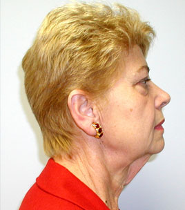 Facelift Before & After Image