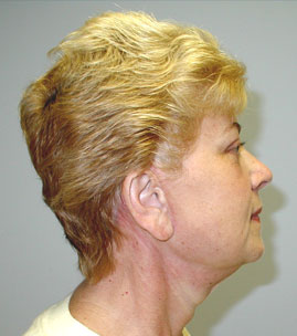 Facelift Before & After Image