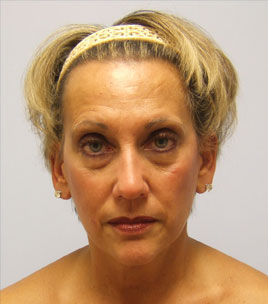 Facelift Before & After Image