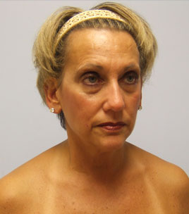 Facelift Before & After Image