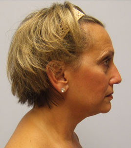 Facelift Before & After Image