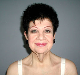 Facelift Before & After Image