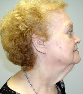 Facelift Before & After Image