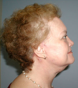 Facelift Before & After Image