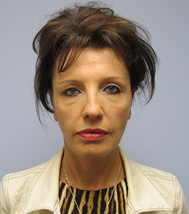 Facelift Before & After Image