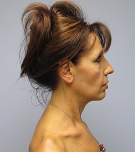 Facelift Before & After Image