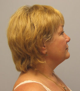 Facelift Before & After Image