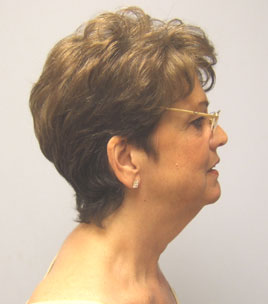 Facelift Before & After Image