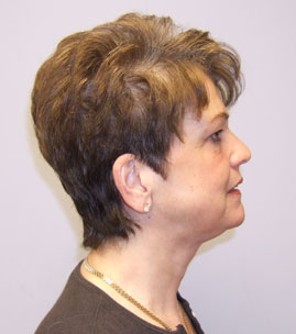 Facelift Before & After Image