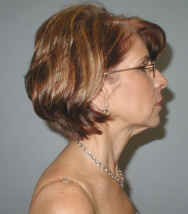 Facelift Before & After Image