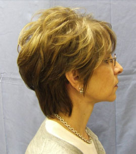 Facelift Before & After Image