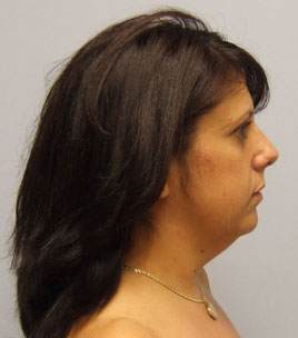 Facelift Before & After Image