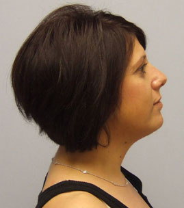 Facelift Before & After Image